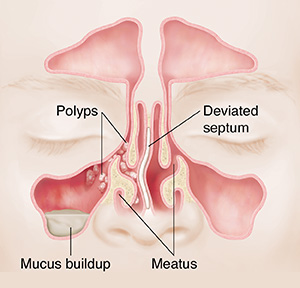 Front view of sinuses showing polyps, mucus buildup, and deviated septum.