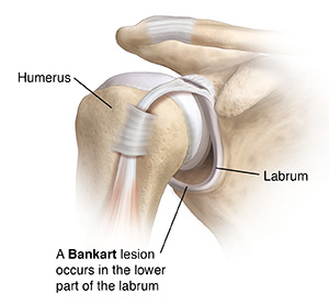 Front view of shoulder joint showing Bankart lesion..