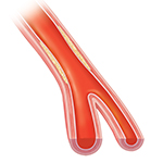 Cross section of artery showing compressed plaque and blood flowing freely.