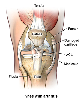 Frente, vista, joelho, mostrando, osteoarthritis