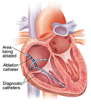 Cross section of heart showing catheters inserted into right atrium. One catheter is destroying tissue on atrium wall.