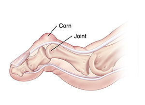 Side view of toe showing corn and rigid hammertoe.