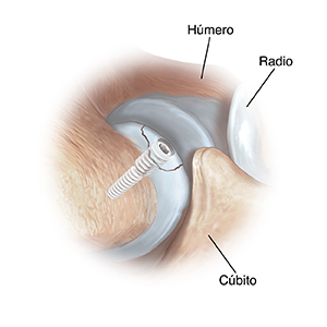 Vista lateral de la articulación del codo donde puede verse un tornillo que sostiene el cartílago en su lugar.