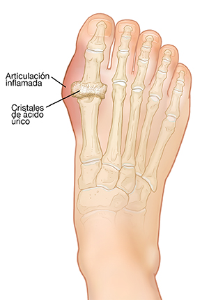 Vista dorsal de un pie con huesos inflamados debido a la gota y cristales de ácido úrico.