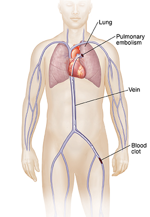 blood clot travel from leg to lungs