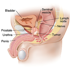 Side view of male pelvic organs showing tumor in prostate.