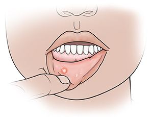 Closeup of mouth with finger holding down lower lip to show canker sore.