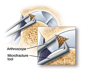 Cross section of hip joint with femoral head moved out of socket. Part of cartilage lining socket is damaged. Arthroscope tip is near damage. Microfracture tool is creating small holes in bone under cartilage damage.