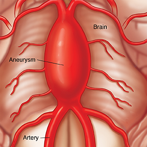 Closeup of brain showing artery with fusiform aneurysm.