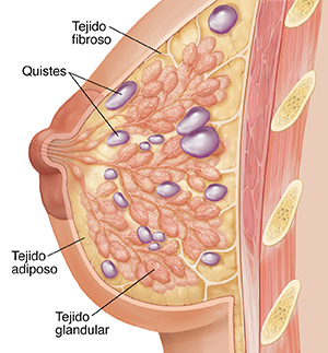 Corte transversal visto de lado de un seno que muestra tejido glandular, tejido fibroso y tejido graso. Se ven múltiples quistes en el tejido del seno.