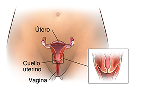 Vista frontal de la pelvis de una mujer, donde se observa un corte transversal del útero, del cuello uterino y de la vagina. En el recuadro, se muestra un primer plano del cuello uterino.