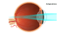 Ilustración sobre astigmatismo