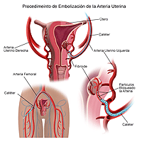 Ilustración de un procedimiento de embolización de las arterias uterinas