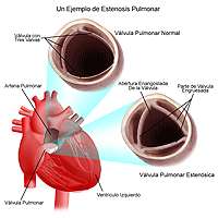 Ilustración de estenosis pulmonar