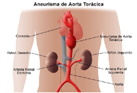 Ilustración de aneurisma de aorta torácica