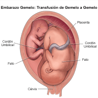 Ilustración de un nacimiento de mellizos, transfusión fetofetal 