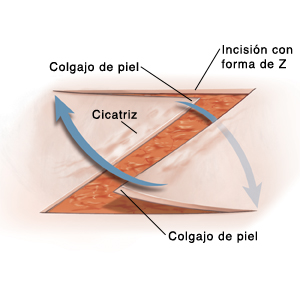 Incisión cutánea de Z-plastia con flechas que muestran el movimiento de los colgajos.