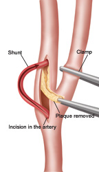 Illustration of carotid endarterectomy