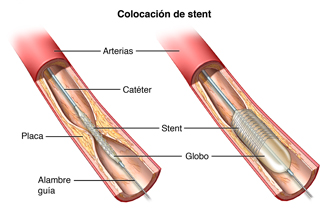 Parte de una arteria que muestra la acumulación de placa. Un catéter y stent están colocados.