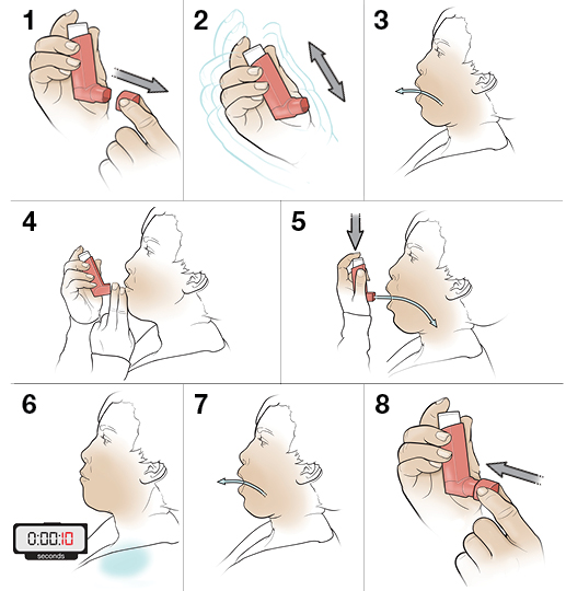 Step-by-Step: Using an Inhaler (Open Mouth) Without a Spacer