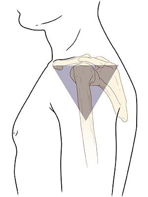 Vista lateral del brazo de un hombre que muestra un triángulo sombreado sobre la piel de la articulación del hombro.