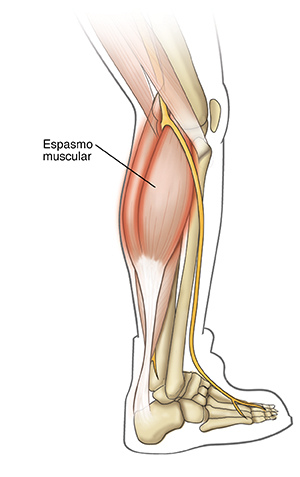 Contorno de la parte inferior de la pierna derecha que muestra cómo se contraen los músculos de la pantorrilla en un espasmo.