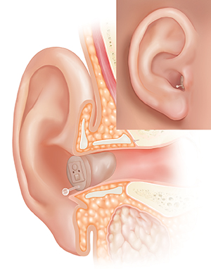Corte transversal del oído donde se observa el oído externo con un audífono colocado en su totalidad en el conducto auditivo externo y un recuadro en el que se muestra la vista externa.