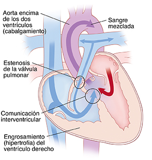 Vista de las cuatro cavidades del corazón que muestra tetralogía de Fallot: la aorta encima de ambos ventrículos, estenosis valvular pulmonar, comunicación interventricular y ventrículo derecho engrosado). Las flechas indican que la sangre fluye desde el ventrículo izquierdo hacia el ventrículo derecho e ingresa en la aorta. Algo de sangre circula desde el lado derecho del corazón a la arteria pulmonar.