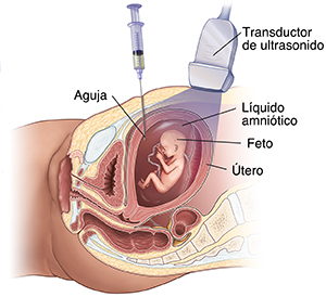 Vista lateral de la zona pélvica femenina en la que se realiza una amniocentesis.