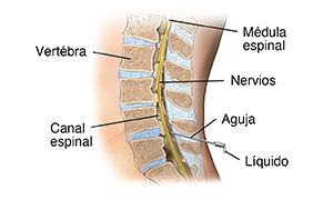 Corte transversal visto de lado de la parte inferior de la espalda, donde se muestra la aguja insertada para la punción lumbar.