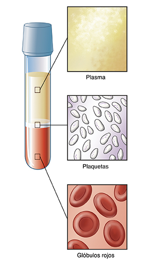 Frasco de sangre separado en partes, con un primer plano del plasma, las plaquetas y los glóbulos rojos.