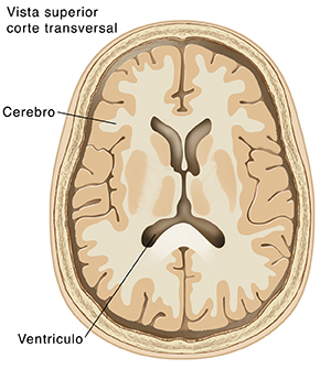 Vista superior de un corte transversal del cerebro donde pueden verse los ventrículos.