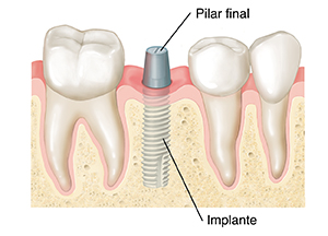 Corte transversal de un diente, donde puede verse la mandíbula y la encía. Hay un implante en el hueso y un pilar unido al implante por encima de la encía.
