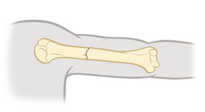 Parte superior del brazo donde se observa una fractura cerrada.