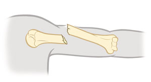 Vista lateral de un dedo con fractura por avulsión.