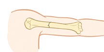 Parte superior del brazo donde se observa una fractura sin desplazamiento.