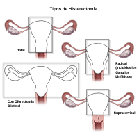 Ilustración de los diferentes tipos de histerectomía