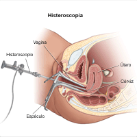 Ilustración del procedimiento de histeroscopía