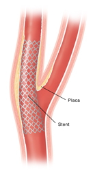 Angioplastia de la arteria carótida con colocación de stents