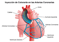 Ilustración de las arterias coronarias después de la inyección del colorante utilizado en el cateterismo cardíaco o PTCA