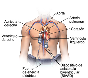 Vista frontal del pecho de un hombre, donde se observa una dispositivo de asistencia biventricular conectado al corazón.