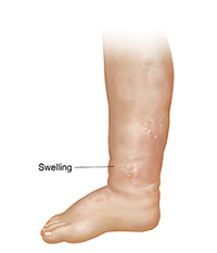 Side view of leg showing ankle and foot swelling.