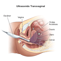 Ilustración del procedimiento de ultrasonido transvaginal
