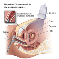 Ilustración que demuestra un muestreo de vellosidad coriónica transcervical