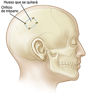 Vista lateral de una cabeza en la que puede verse el cráneo con orificios de trepanación para una craneotomía.