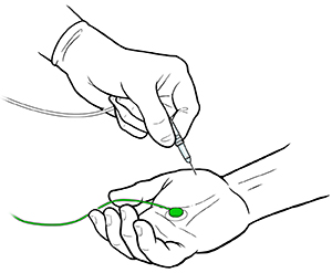 Primer plano de un brazo con el parche de electrodos en la mano. Una mano enguantada inserta una aguja en un músculo de la palma.